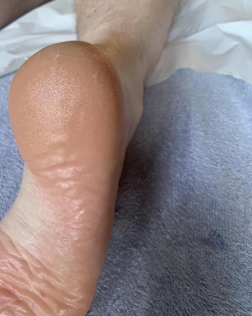 before and after microdermabrasion the blissful beauty company