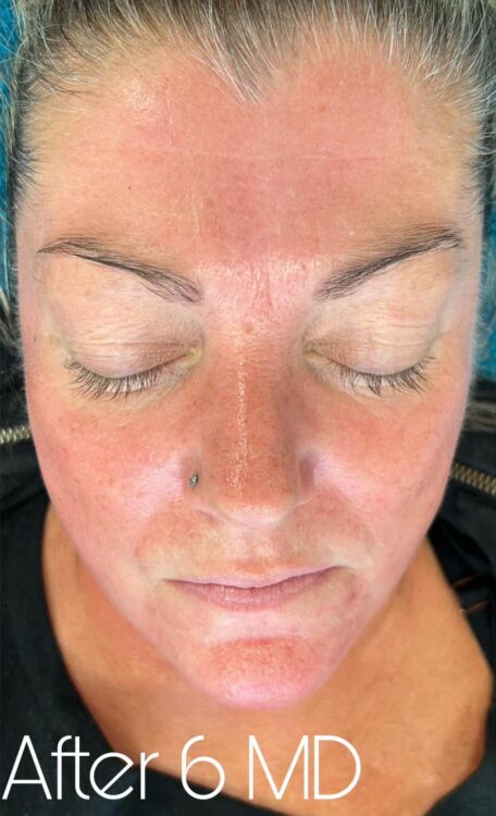 before and after microdermabrasion the hg aesthetics clinic
