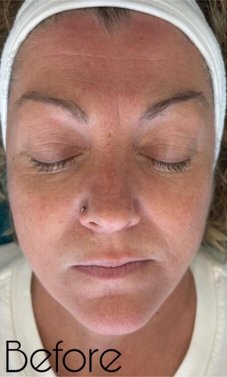 before and after microdermabrasion the hg aesthetics clinic