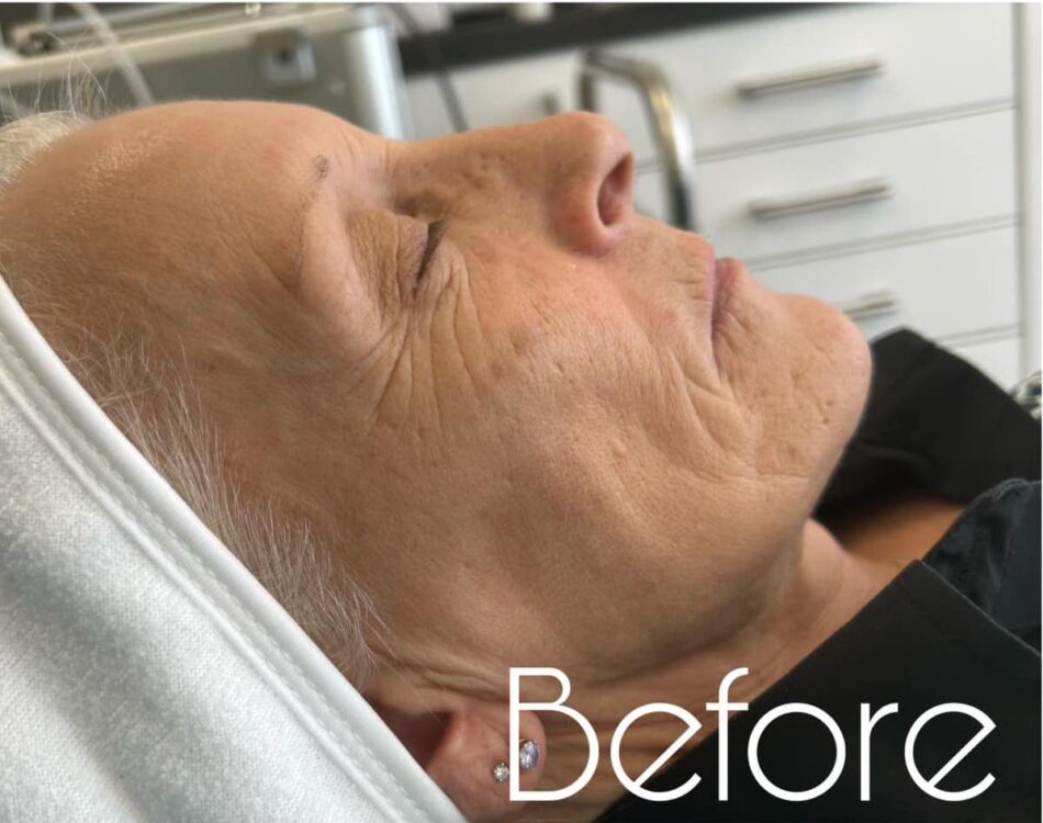 before and after microdermabrasion the hg clinic