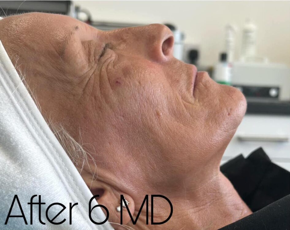 before and after microdermabrasion the hg clinic
