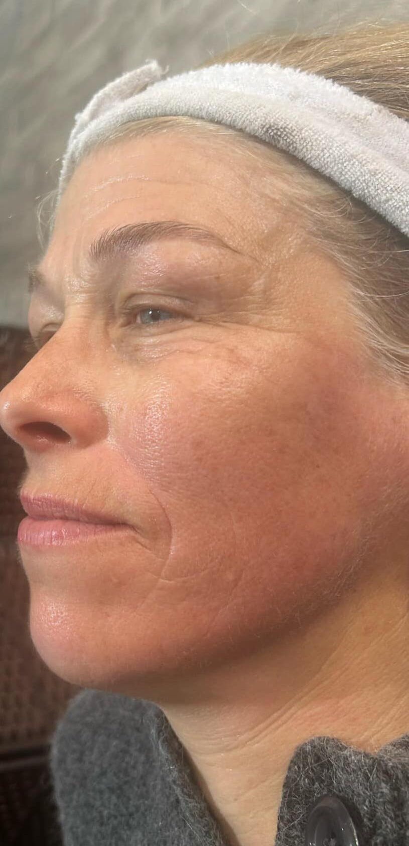 before and after collagen lift the hidden jem