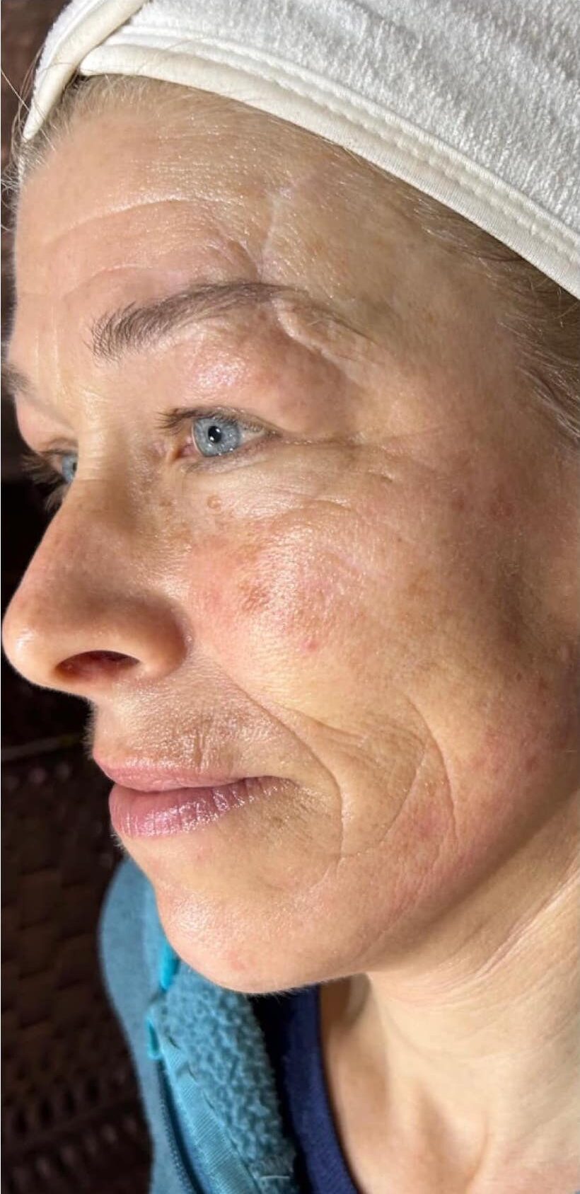 before and after collagen lift the hidden jem