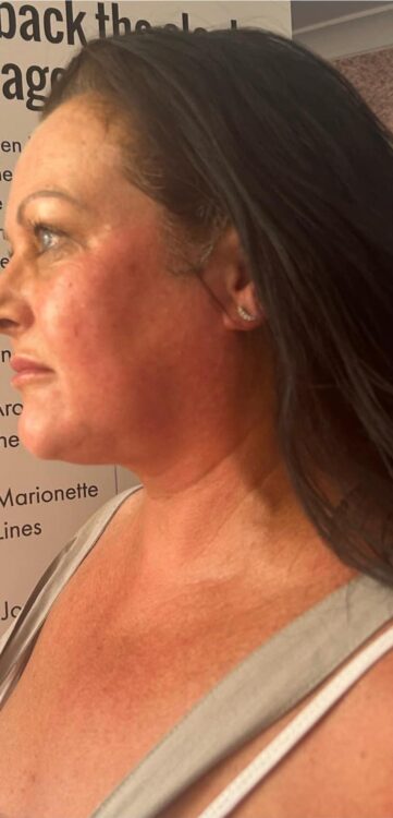 before and after collagen lift the hidden jem