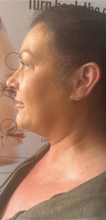 before and after collagen lift the hidden jem
