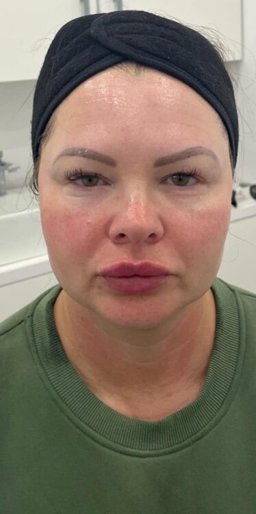 before and after collagen lift the skin and body clinic Essex