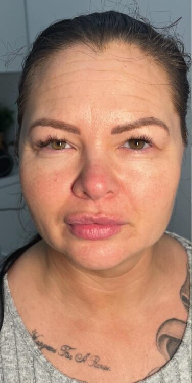 before and after collagen lift the skin and body clinic Essex