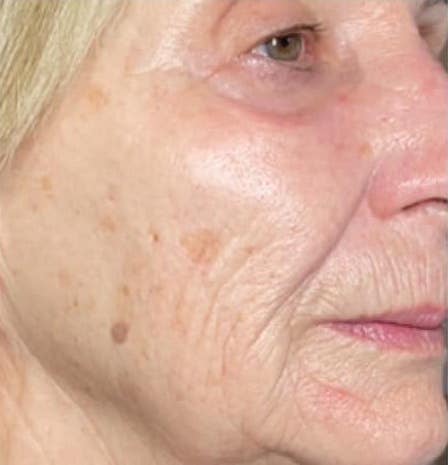 before and after microdermabrasion the skin refinery