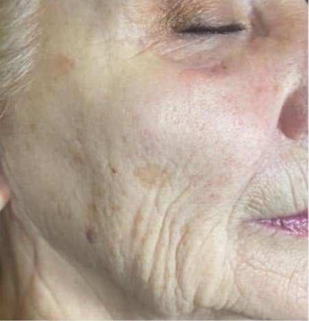 before and after microdermabrasion the skin refinery