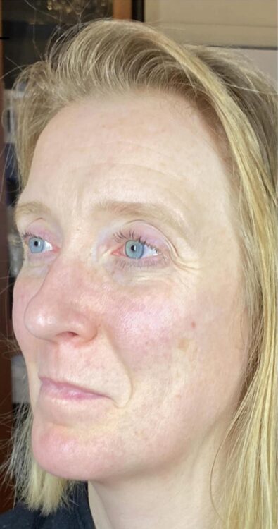 before and after microdermabrasion the skin refinery