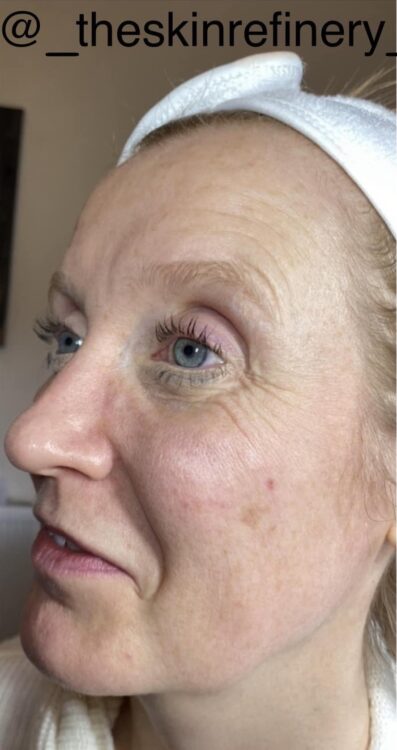 before and after microdermabrasion the skin refinery