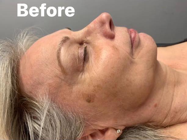 before and after microdermabrasion twinkle with glamour