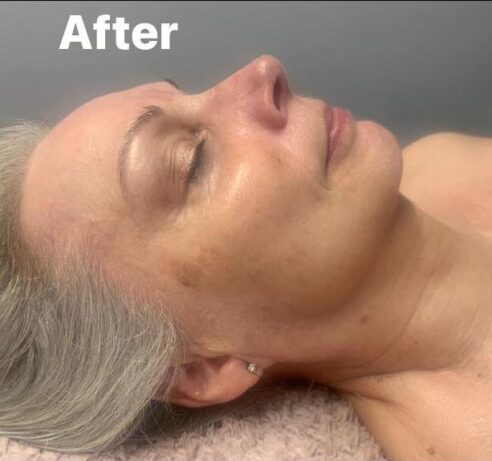 before and after microdermabrasion twinkle with glamour
