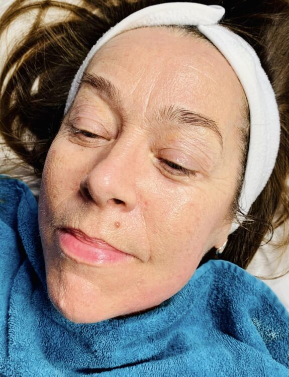before and after collagen lift ugly duckling beauty