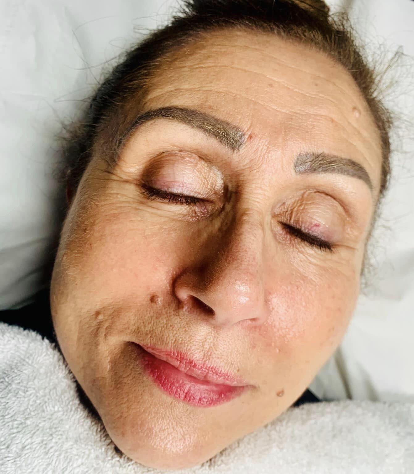 before and after collagen lift ugly duckling beauty