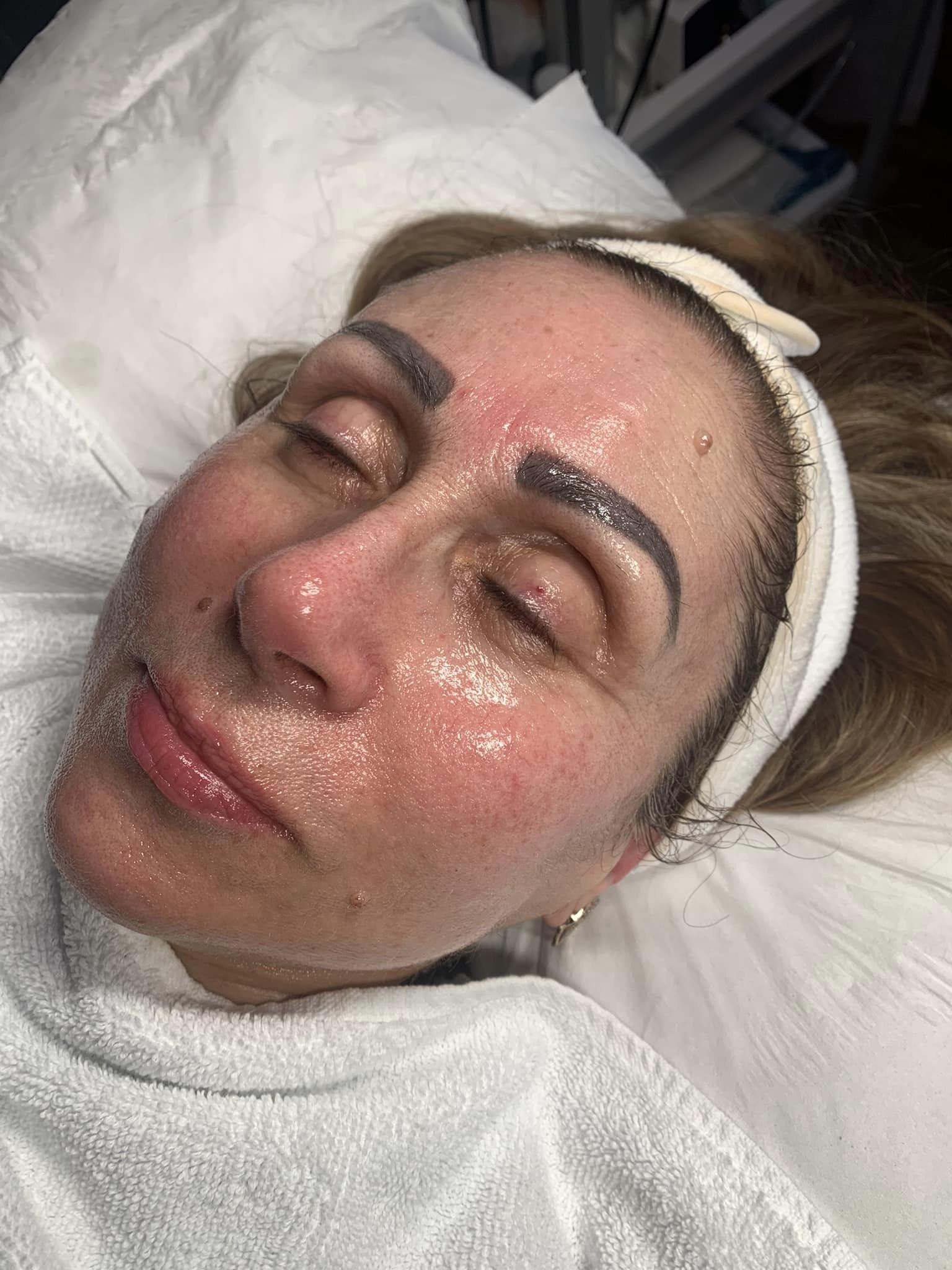 before and after collagen lift ugly duckling beauty