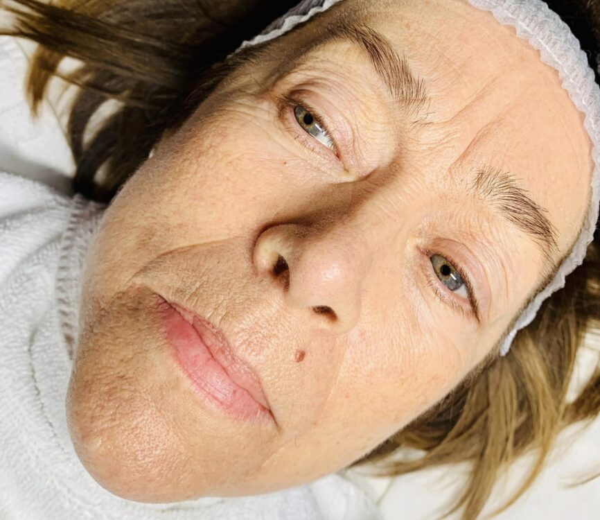 before and after collagen lift ugly duckling beauty