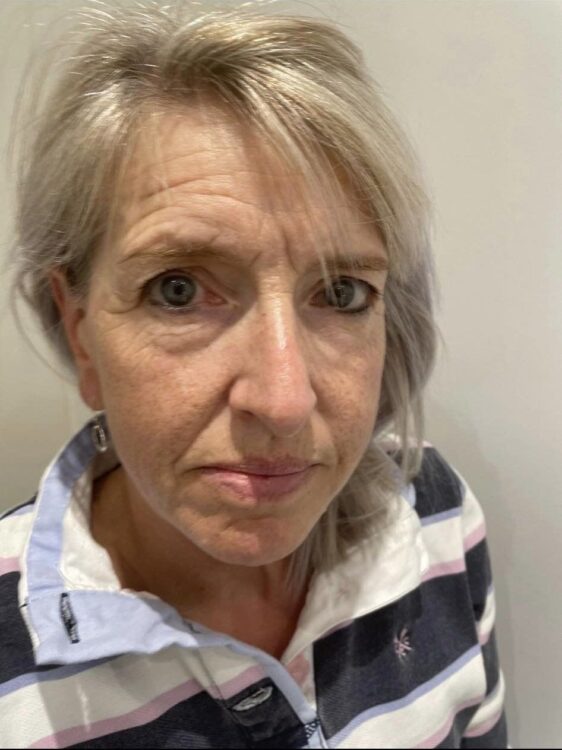 before and after collagen lift waxed by lex