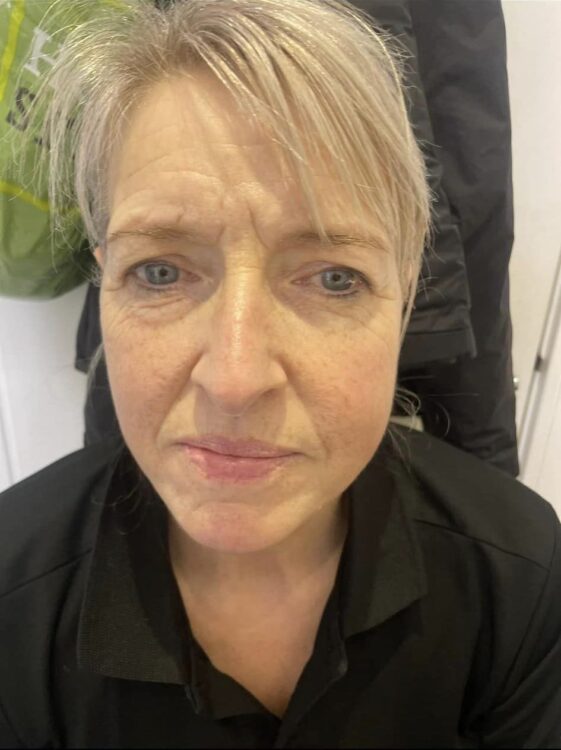 before and after collagen lift waxed by lex