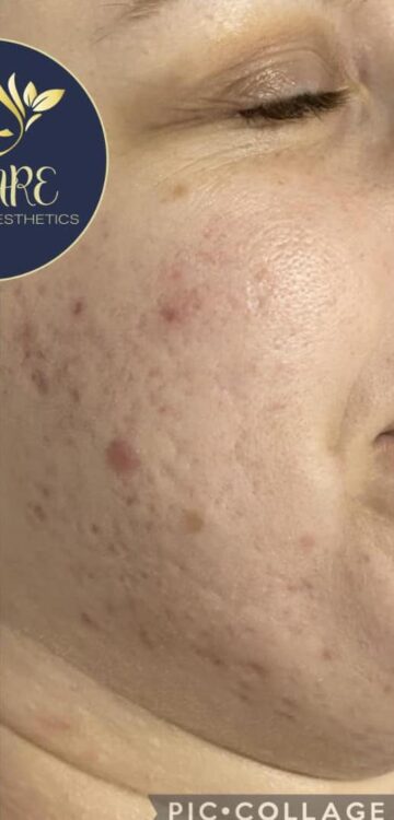 before and after microdermabrasion weare beauty and aesthetics