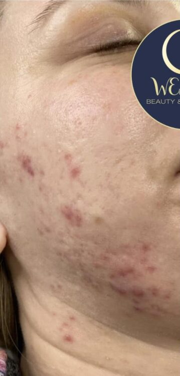 before and after microdermabrasion weare beauty and aesthetics