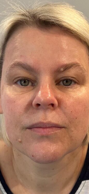 before and after collagen lift z's beautique