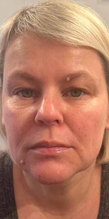 before and after collagen lift z's beautique