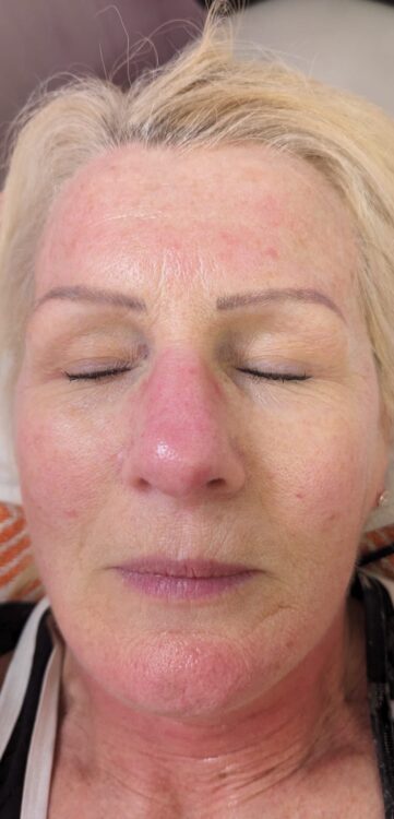 before and after collagen lift Hollywood beauty
