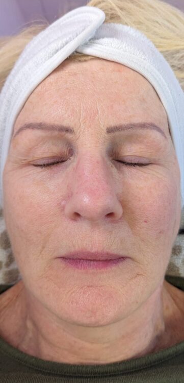 before and after collagen lift Hollywood beauty