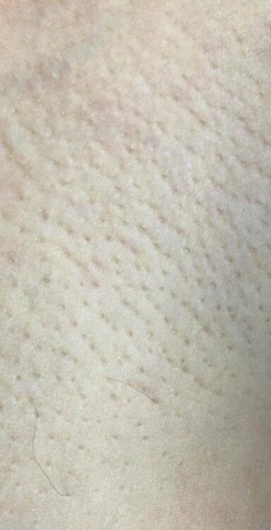 before and after IPL Hair Reduction the beauty room kettering