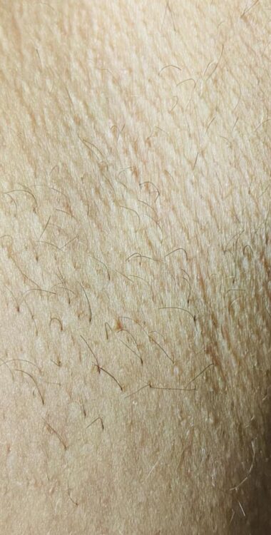 before and after IPL Hair Reduction the beauty room kettering