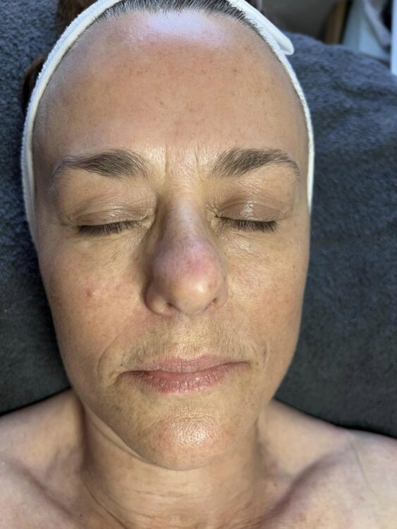 before and after microdermabrasion TLV beauty