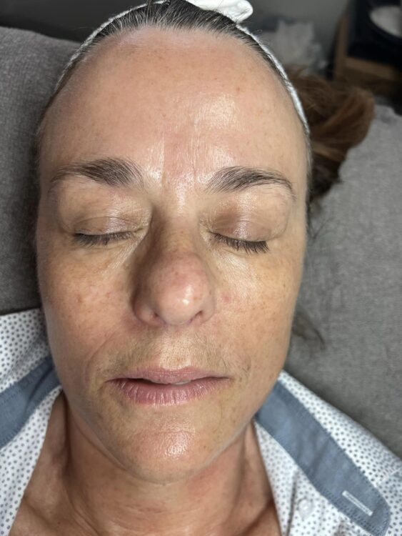 before and after microdermabrasion TLV beauty
