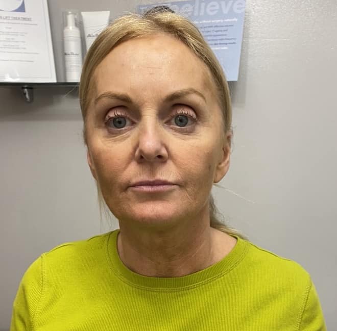 before and after collagen lift 2 advanced beauty with anne marie ling 1