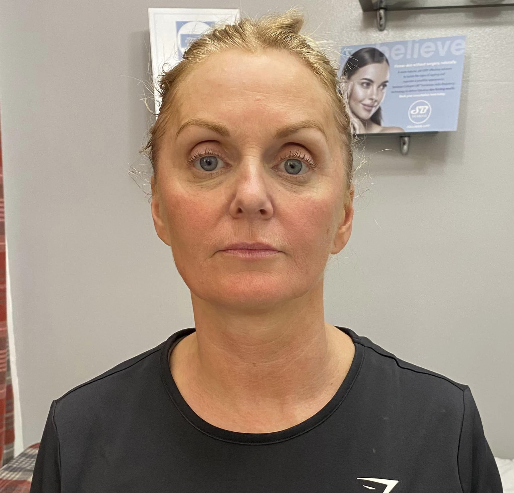 before and after collagen lift 2 advanced beauty with anne marie ling 2