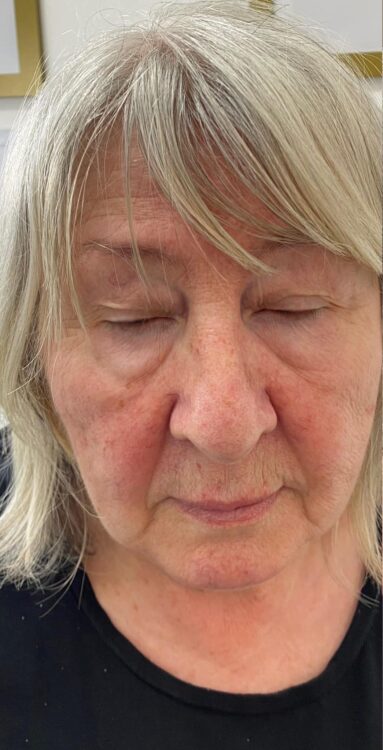 before and after collagen lift 2 salon symphony 1