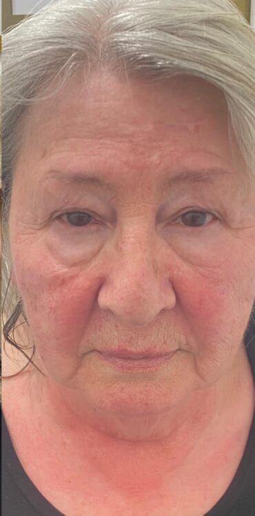 before and after collagen lift 2 salon symphony 2