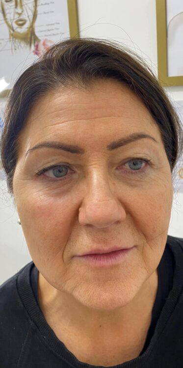before and after collagen lift 3 salon symphony 1