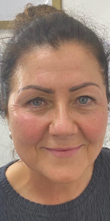 before and after collagen lift 3 salon symphony 2