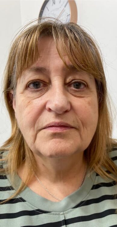 before and after collagen lift 4 salon symphony 1