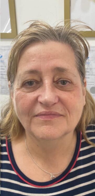 before and after collagen lift 4 salon symphony 2