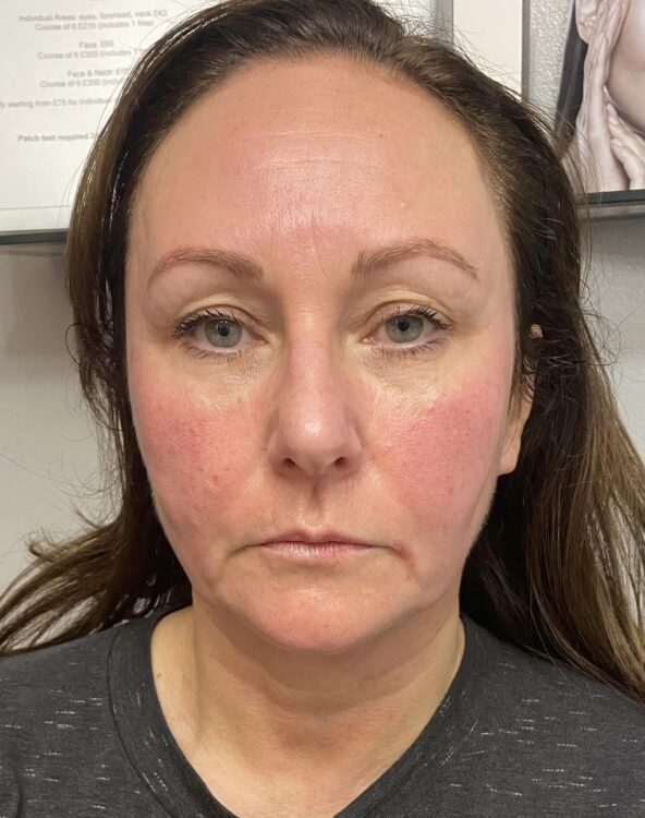 before and after collagen lift advanced beauty with anne marie ling 1