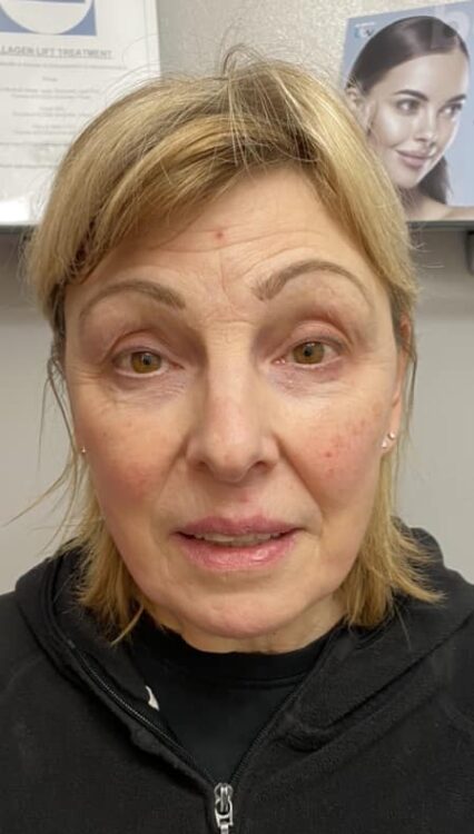 before and after collagen lift advanced beauty with anne marie ling 1