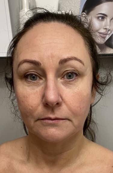before and after collagen lift advanced beauty with anne marie ling 2
