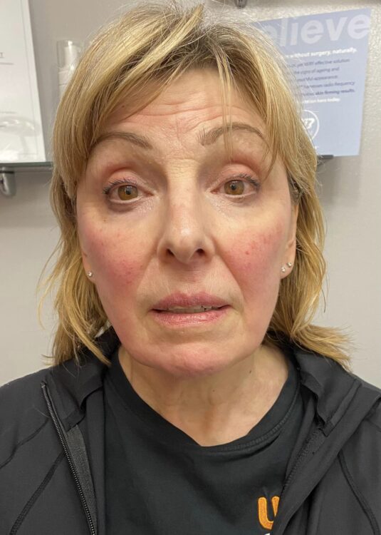 before and after collagen lift advanced beauty with anne marie ling 2