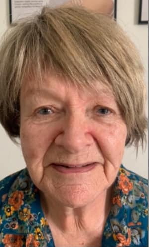 before and after collagen lift amy marsden beauty 1