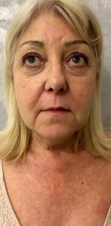 before and after collagen lift ayano spa 1