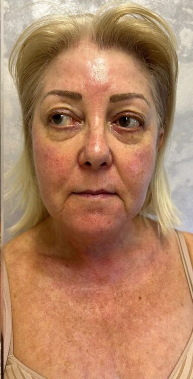 before and after collagen lift ayano spa 2