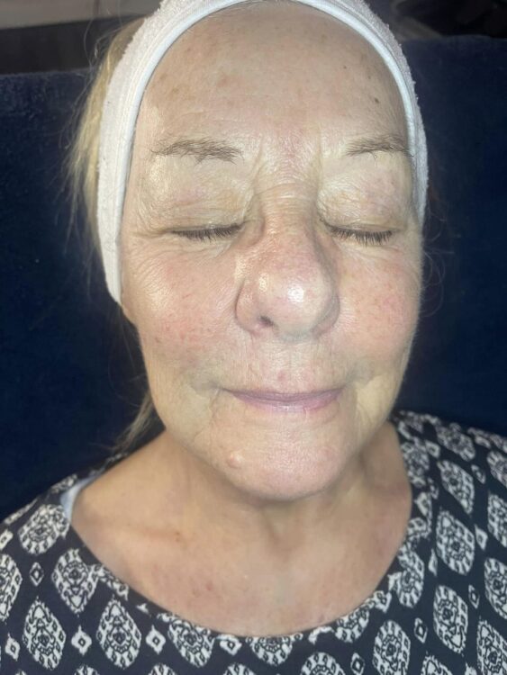 before and after collagen lift bank of beauty 1