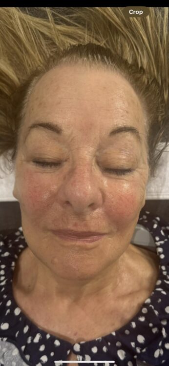 before and after collagen lift bank of beauty 2